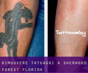 Rimuovere Tatuaggi a Sherwood Forest (Florida)