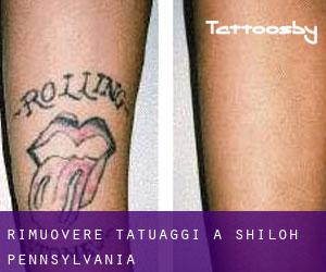 Rimuovere Tatuaggi a Shiloh (Pennsylvania)