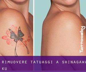 Rimuovere Tatuaggi a Shinagawa-ku