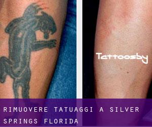 Rimuovere Tatuaggi a Silver Springs (Florida)