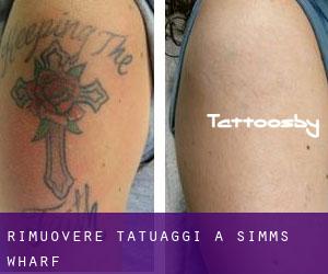 Rimuovere Tatuaggi a Simms Wharf