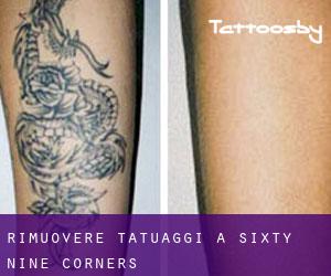 Rimuovere Tatuaggi a Sixty-Nine Corners