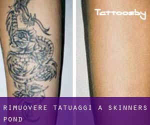 Rimuovere Tatuaggi a Skinners Pond