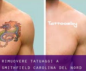 Rimuovere Tatuaggi a Smithfield (Carolina del Nord)