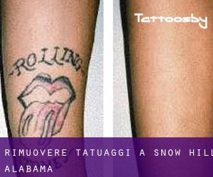 Rimuovere Tatuaggi a Snow Hill (Alabama)