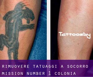 Rimuovere Tatuaggi a Socorro Mission Number 1 Colonia
