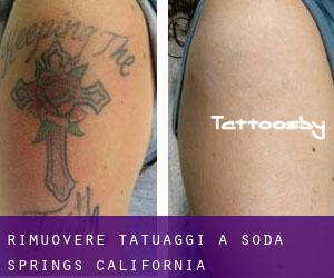 Rimuovere Tatuaggi a Soda Springs (California)