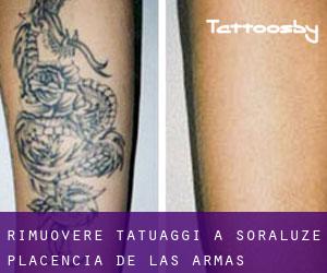Rimuovere Tatuaggi a Soraluze / Placencia de las Armas