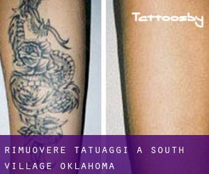 Rimuovere Tatuaggi a South Village (Oklahoma)