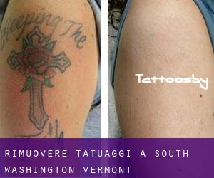 Rimuovere Tatuaggi a South Washington (Vermont)