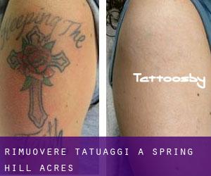 Rimuovere Tatuaggi a Spring Hill Acres