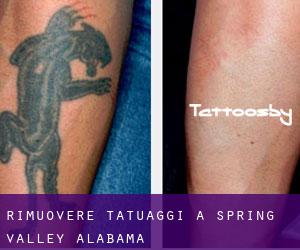 Rimuovere Tatuaggi a Spring Valley (Alabama)