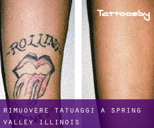 Rimuovere Tatuaggi a Spring Valley (Illinois)