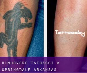 Rimuovere Tatuaggi a Springdale (Arkansas)