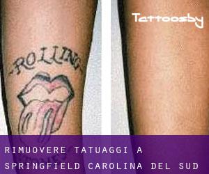 Rimuovere Tatuaggi a Springfield (Carolina del Sud)