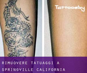 Rimuovere Tatuaggi a Springville (California)