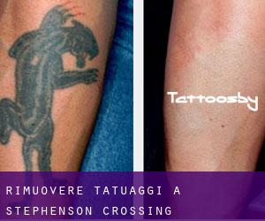 Rimuovere Tatuaggi a Stephenson Crossing