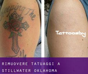Rimuovere Tatuaggi a Stillwater (Oklahoma)