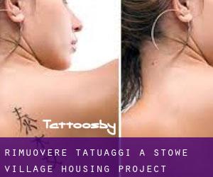 Rimuovere Tatuaggi a Stowe Village Housing Project