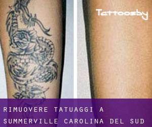 Rimuovere Tatuaggi a Summerville (Carolina del Sud)