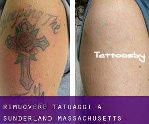 Rimuovere Tatuaggi a Sunderland (Massachusetts)