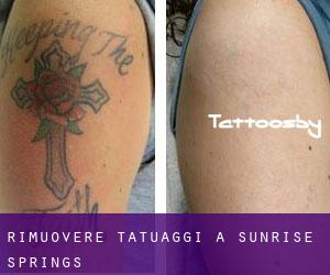 Rimuovere Tatuaggi a Sunrise Springs
