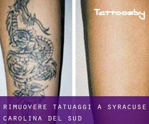Rimuovere Tatuaggi a Syracuse (Carolina del Sud)
