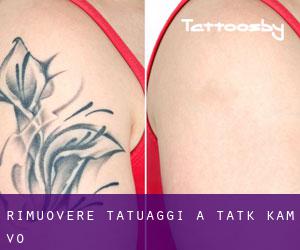 Rimuovere Tatuaggi a Tatk Kam Vo