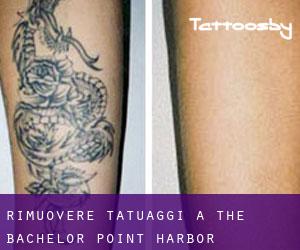 Rimuovere Tatuaggi a The Bachelor Point Harbor