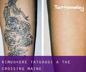 Rimuovere Tatuaggi a The Crossing (Maine)