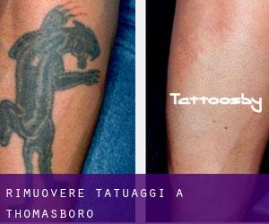 Rimuovere Tatuaggi a Thomasboro