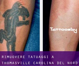 Rimuovere Tatuaggi a Thomasville (Carolina del Nord)