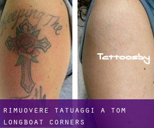 Rimuovere Tatuaggi a Tom Longboat Corners