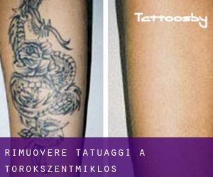 Rimuovere Tatuaggi a Törökszentmiklós