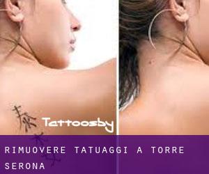 Rimuovere Tatuaggi a Torre-serona