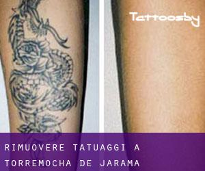 Rimuovere Tatuaggi a Torremocha de Jarama