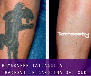 Rimuovere Tatuaggi a Tradesville (Carolina del Sud)