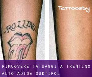 Rimuovere Tatuaggi a Trentino - Alto Adige / Südtirol