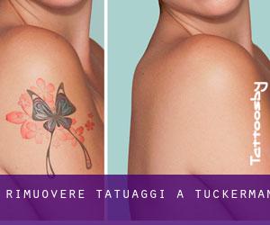 Rimuovere Tatuaggi a Tuckerman