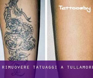 Rimuovere Tatuaggi a Tullamore