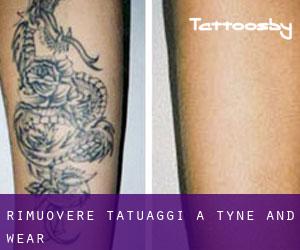 Rimuovere Tatuaggi a Tyne and Wear