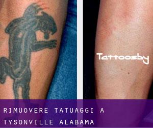 Rimuovere Tatuaggi a Tysonville (Alabama)