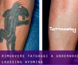 Rimuovere Tatuaggi a Underwood Crossing (Wyoming)