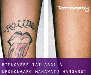 Rimuovere Tatuaggi a Upokongaro (Manawatu-Wanganui)