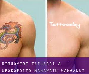 Rimuovere Tatuaggi a Upokopoito (Manawatu-Wanganui)