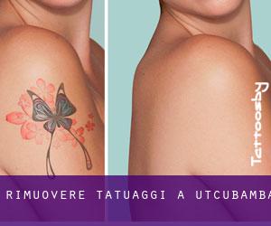 Rimuovere Tatuaggi a Utcubamba