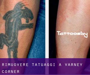 Rimuovere Tatuaggi a Varney Corner