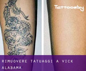 Rimuovere Tatuaggi a Vick (Alabama)