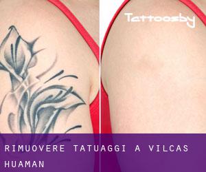 Rimuovere Tatuaggi a Vilcas Huamán