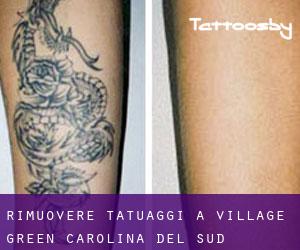 Rimuovere Tatuaggi a Village Green (Carolina del Sud)